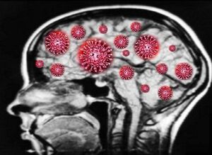 نوع شدید کرونا مغز را تا ۲۰ سال پیر می‌کند