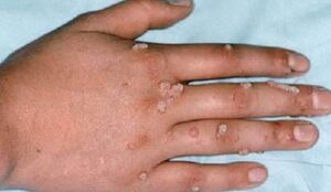 آبله میمون در رادار سازمان جهانی بهداشت