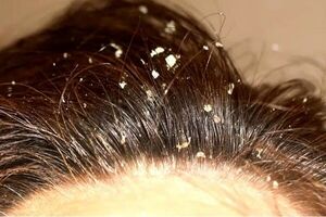 دلایل و عوارض شوره سر