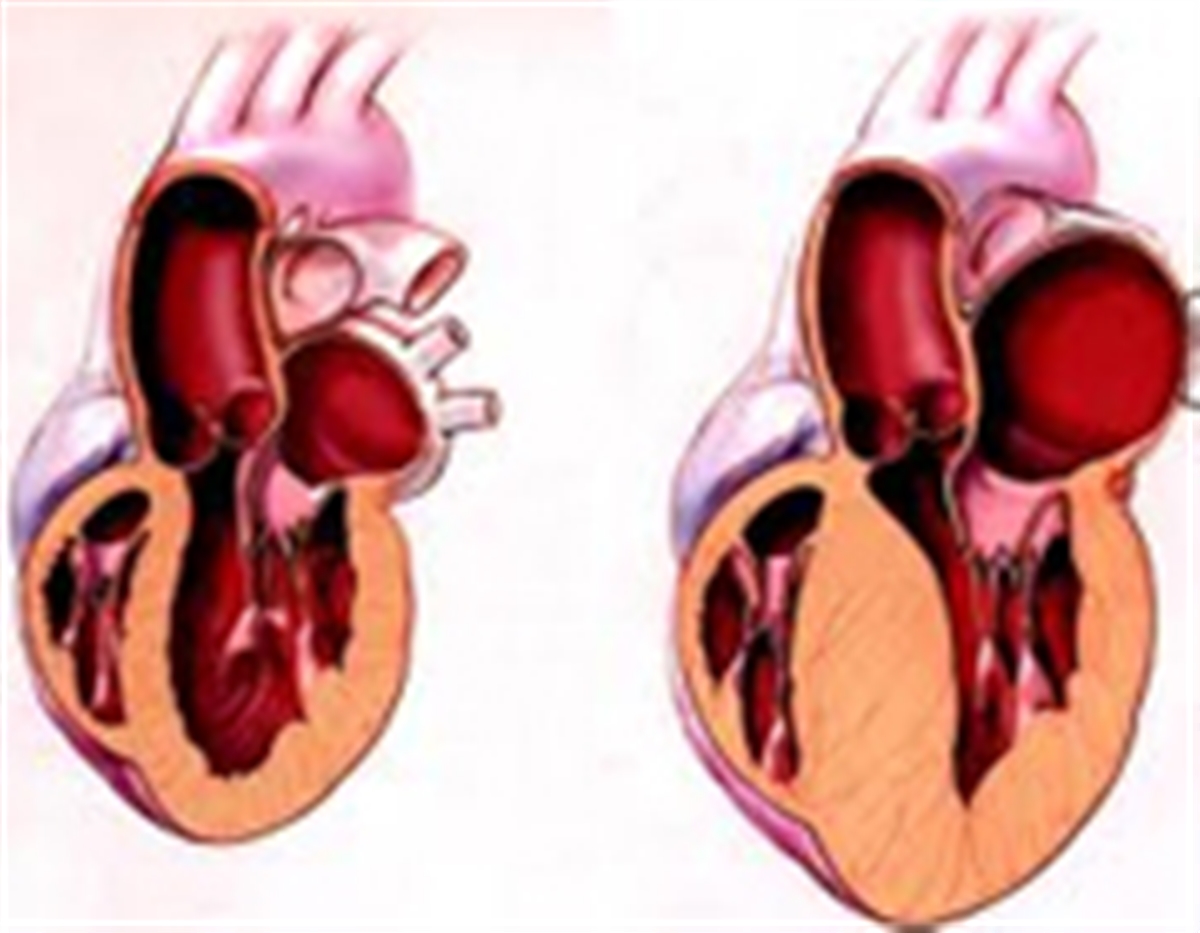 شایع‌ترین علائم بزرگ شدن قلب