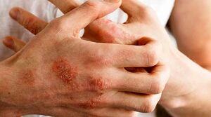 تاثیر استرس بر بیماری‌های پوستی
