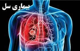 سل چه علائمی دارد و چگونه منتقل می‌شود؟