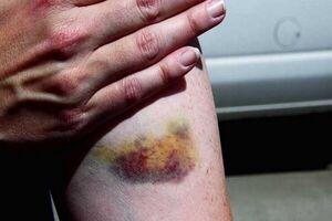 علت کبود شدن بدن چیست؟