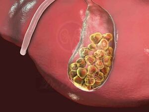 عواملی که باعث ایجاد سنگ مثانه می‌شود