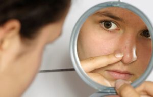 دلیل اصلی جوش زدن بعد از خوردن شکلات