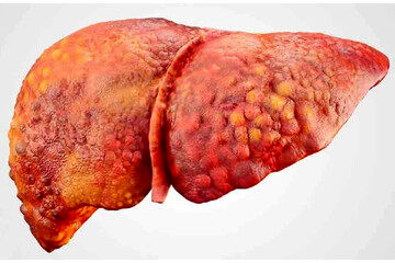 هشدار؛ این ۴ نشانه اصلی گوارشی خبر از کبد چرب می دهد