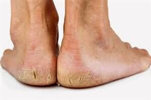 روش ساده برای نابودی ترک کف پا